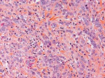 Tableau de classification euopéenne des biopsies mammaires